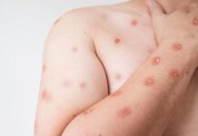 MT intensifica alerta para Mpox após casos em Rondônia