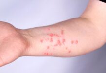 Cuiabá não confirma casos de Mpox em 2026 e mantém alerta preventivo ativo